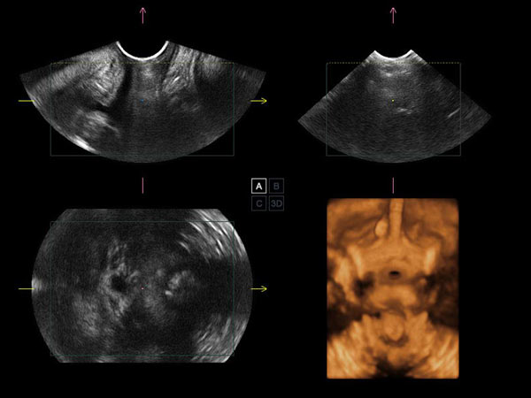 Pelvic Floor 4D